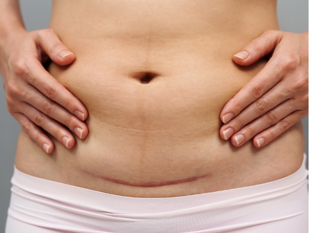 Gentle caesarean scar massage technique